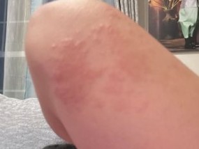 “因为一个常见的健身错误，我被困在家里，一直抓挠自己，直到流血。”