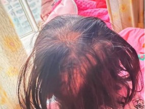 比砒霜还毒！3岁女童大把脱发、走路如踩棉花，查出急性铊中毒