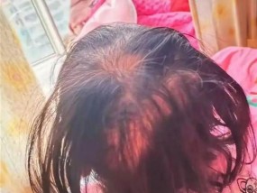 3岁女童脱发、眼神呆滞被查出铊中毒，医院回应：发现得早，已痊愈出院